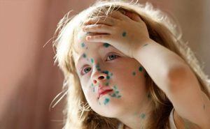 Ветряная оспа в курсе, что с «короной» Минздрав накосячил — и бесчинствует в российских регионах ЗДОРОВЬЕ